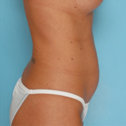 Manhattan abdominoplasty before 2